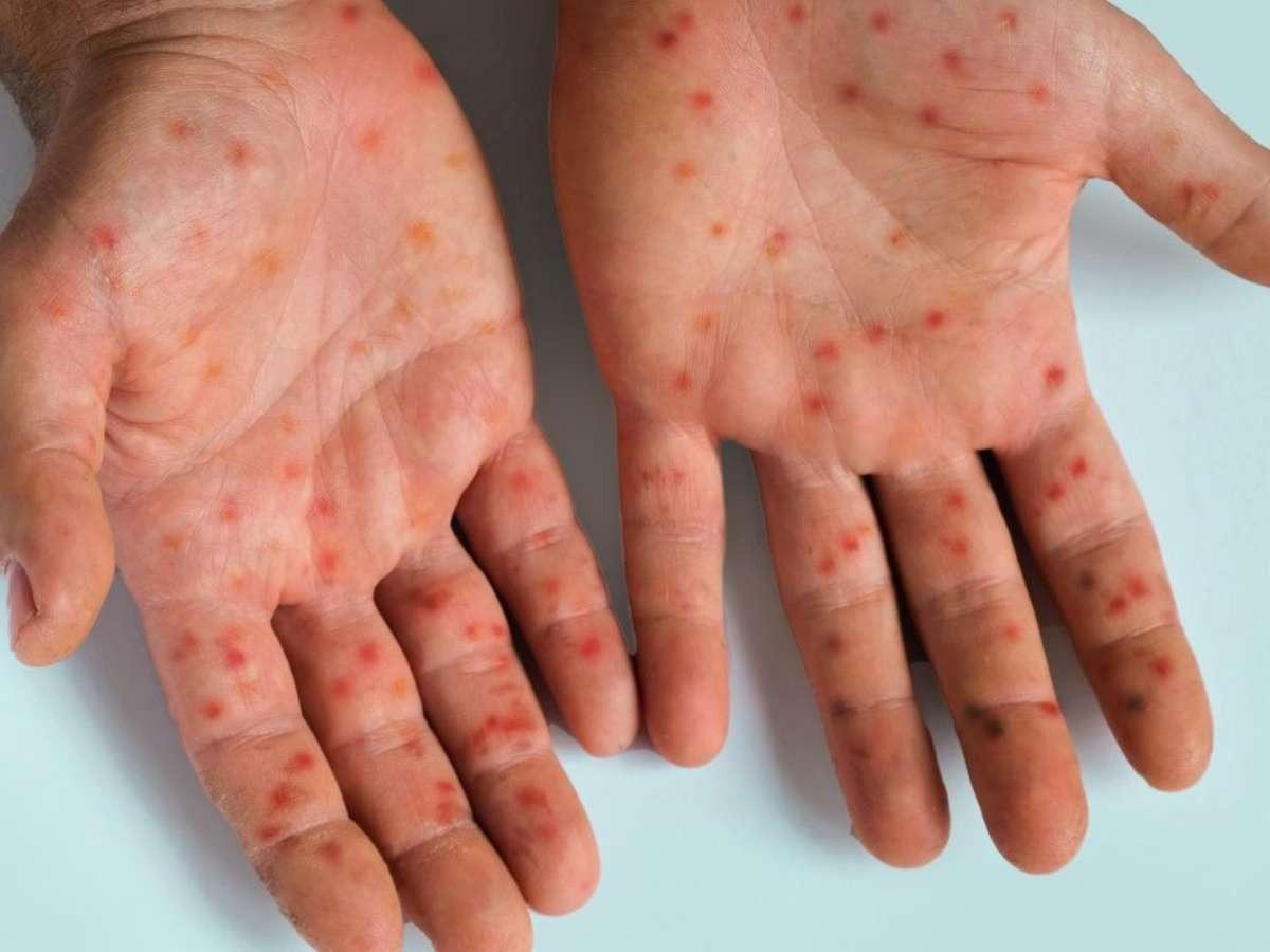 Mpox: conheça sintomas e tire principais dúvidas sobre a doença